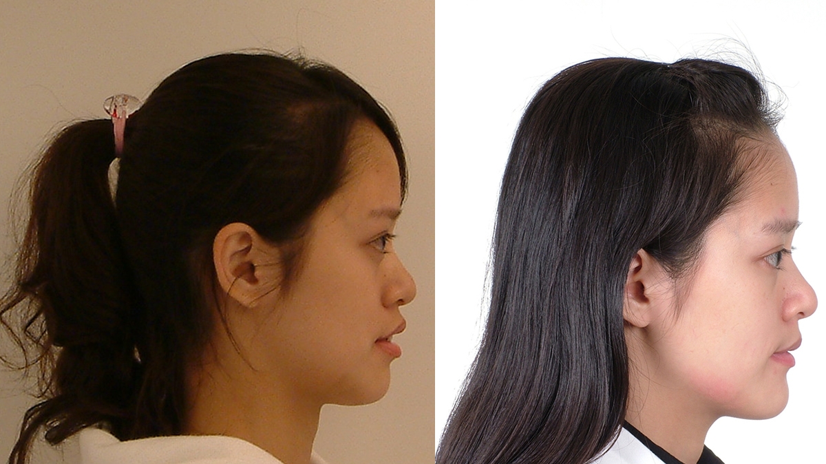 暴牙牙齒矯正對照圖二