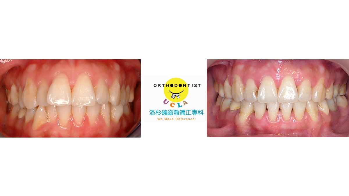 暴牙牙齒矯正對照圖三