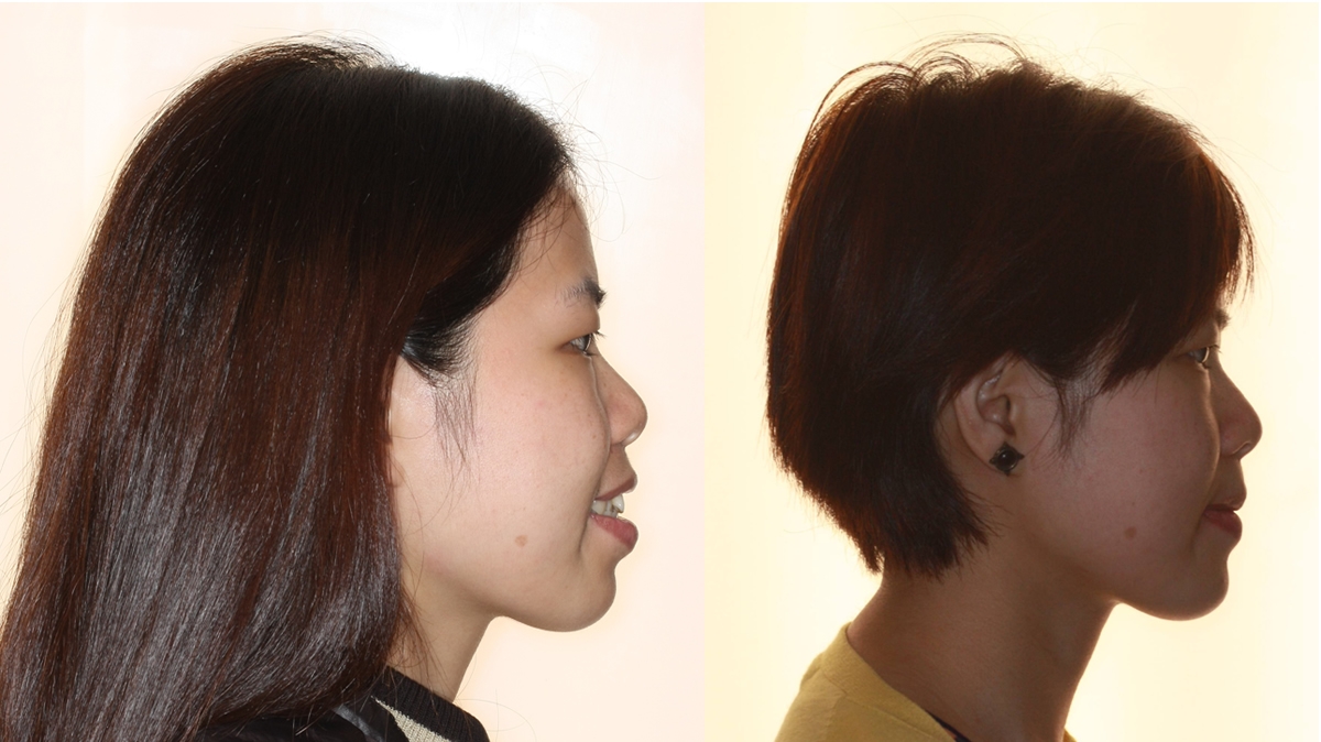 暴牙牙齒矯正對照圖二