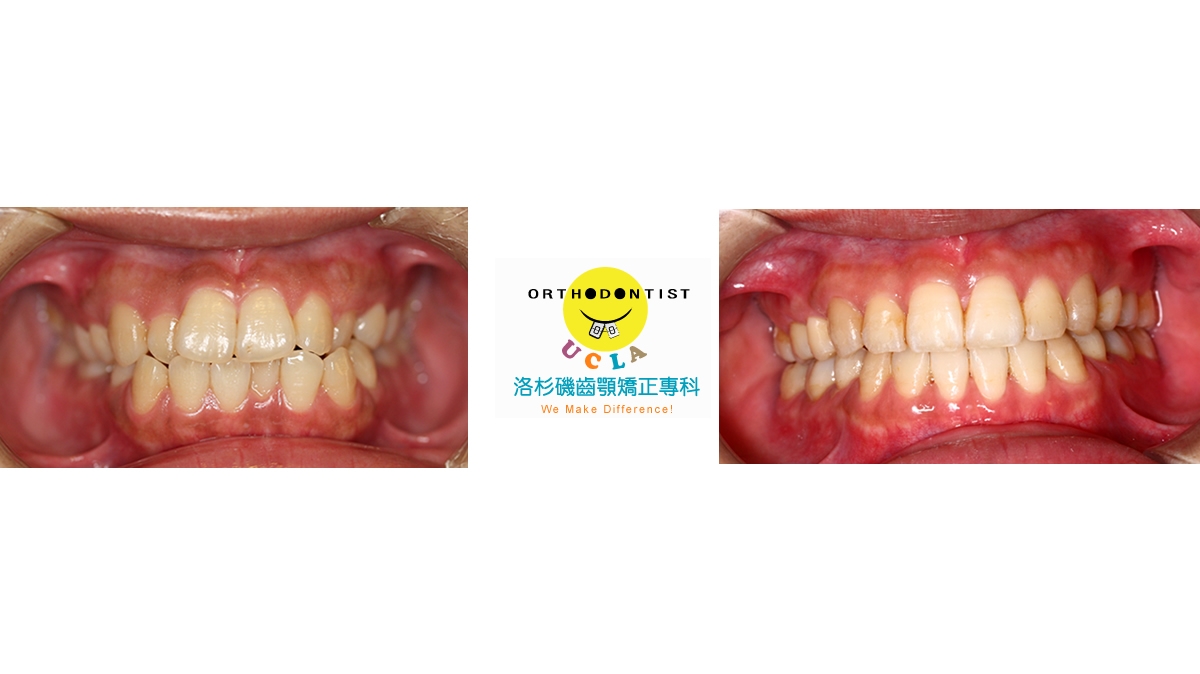 暴牙牙齒矯正對照圖三