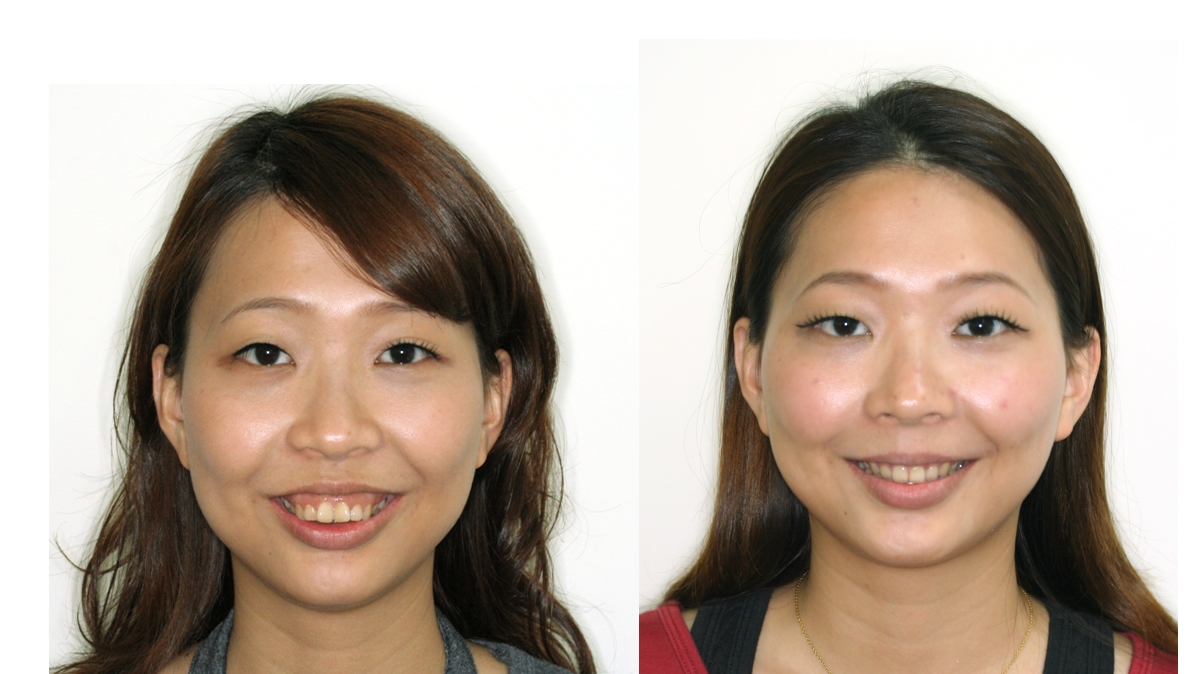 暴牙牙齒矯正對照圖