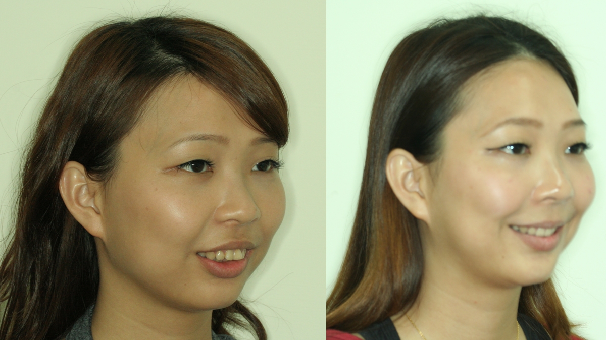 暴牙牙齒矯正對照圖二