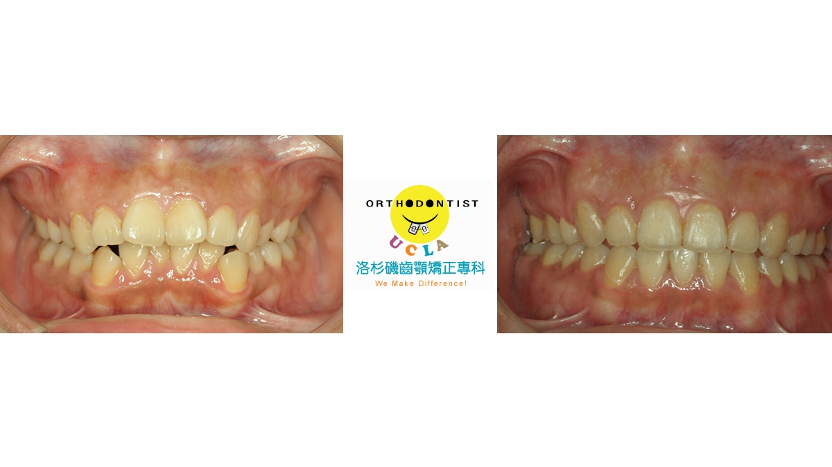 暴牙牙齒矯正對照圖三