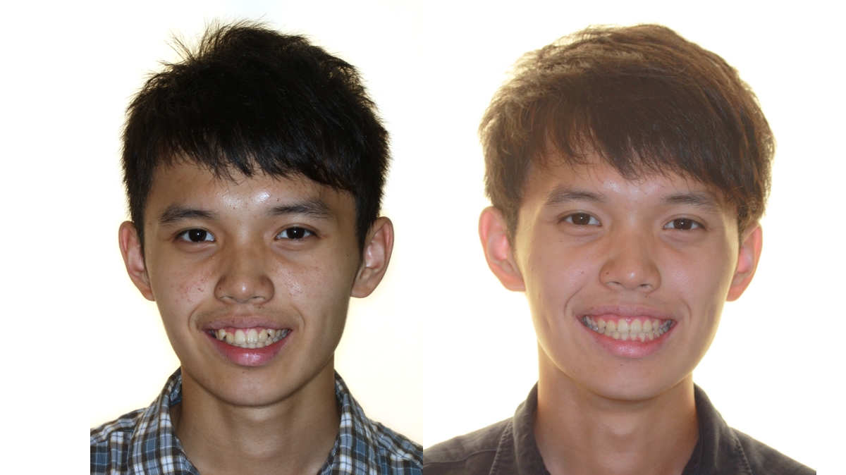 暴牙牙齒矯正對照圖