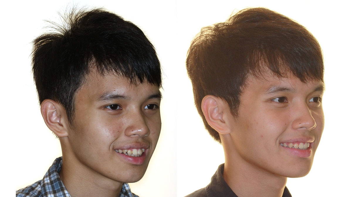 暴牙牙齒矯正對照圖二