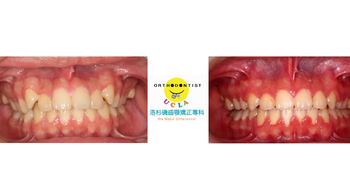 暴牙牙齒矯正對照圖三
