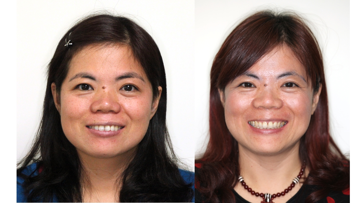 暴牙牙齒矯正對照圖