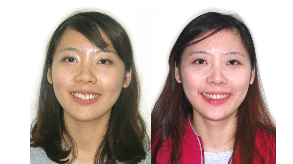 暴牙牙齒矯正對照圖