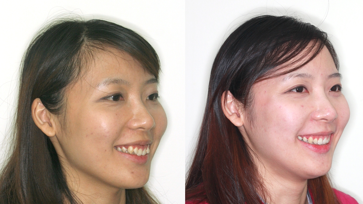 暴牙牙齒矯正對照圖二