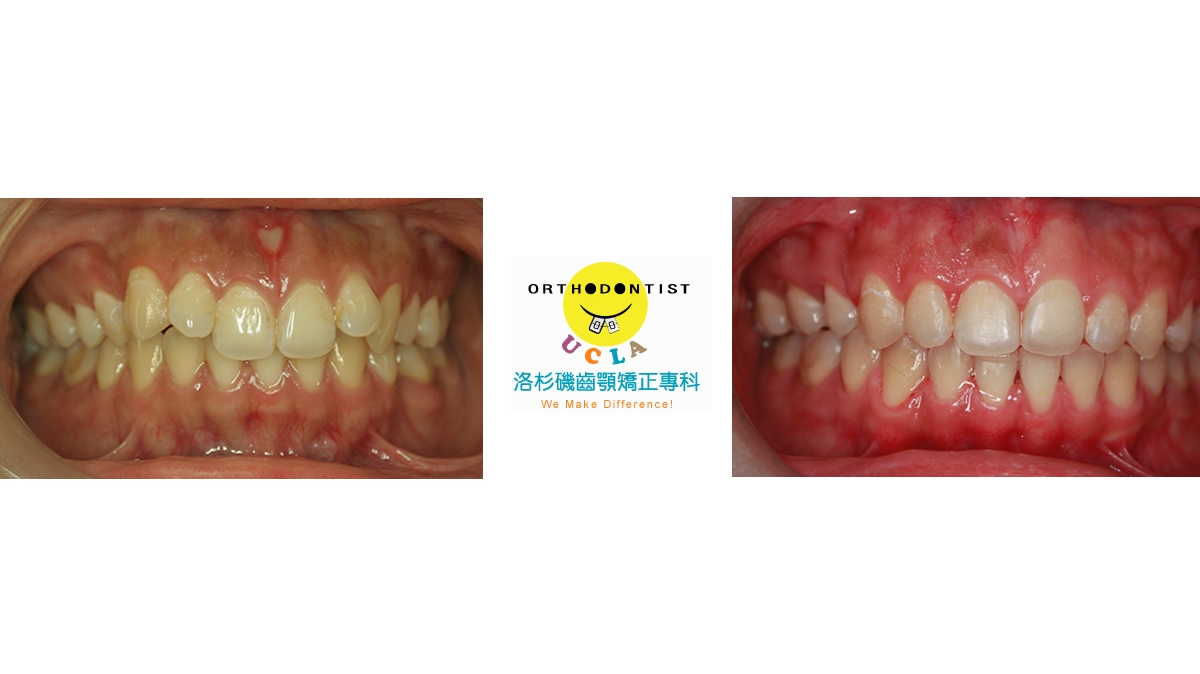 暴牙牙齒矯正對照圖三