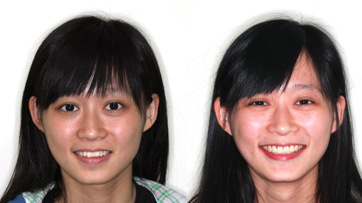 暴牙牙齒矯正對照圖