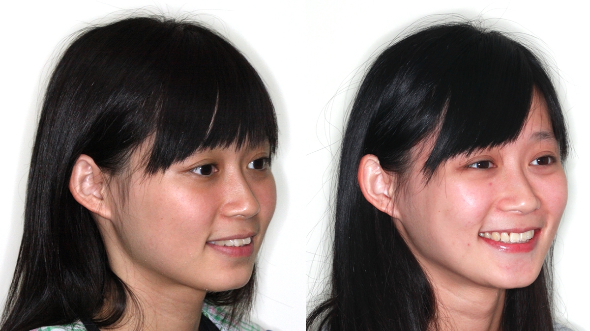 暴牙牙齒矯正對照圖二
