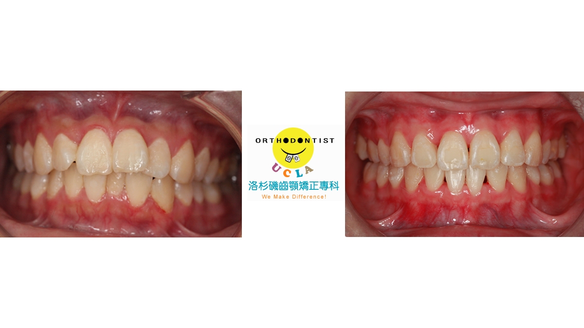 暴牙牙齒矯正對照圖三