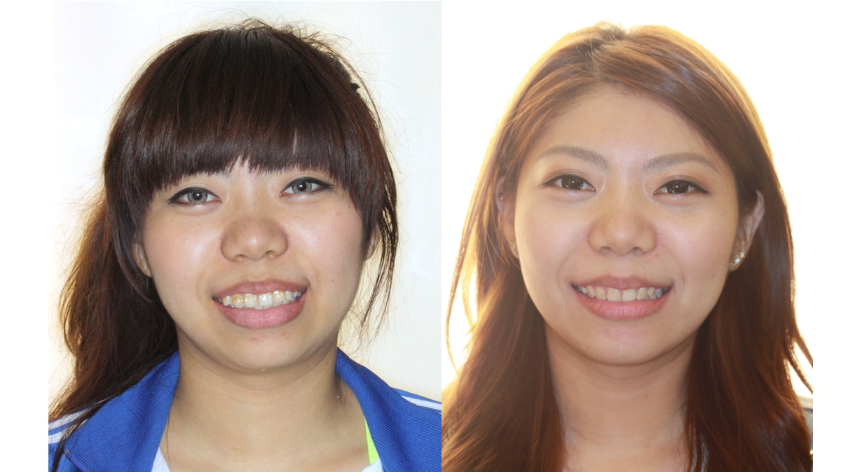 暴牙牙齒矯正對照圖