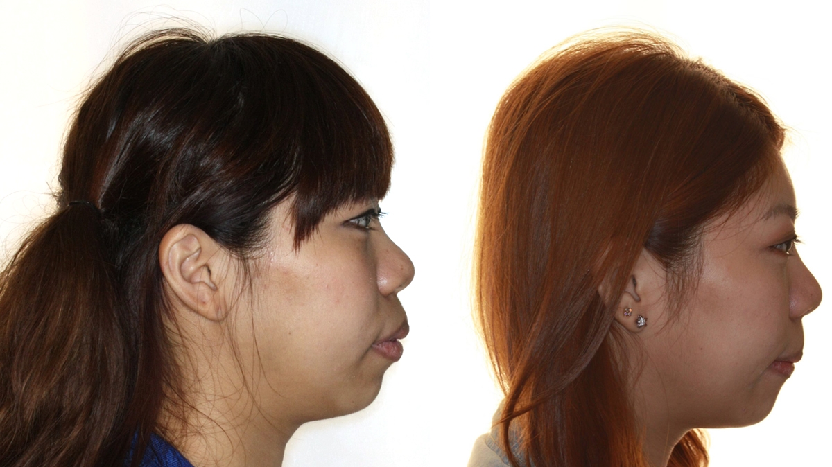 暴牙牙齒矯正對照圖二