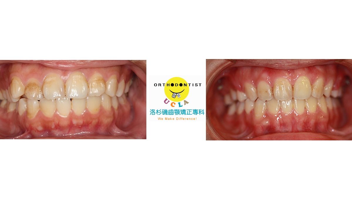 暴牙牙齒矯正對照圖三