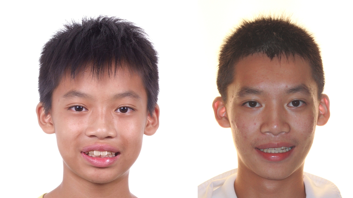暴牙牙齒矯正對照圖