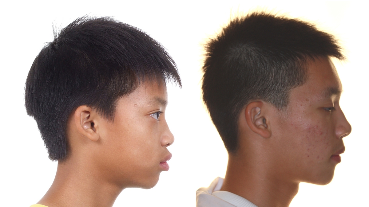 暴牙牙齒矯正對照圖二