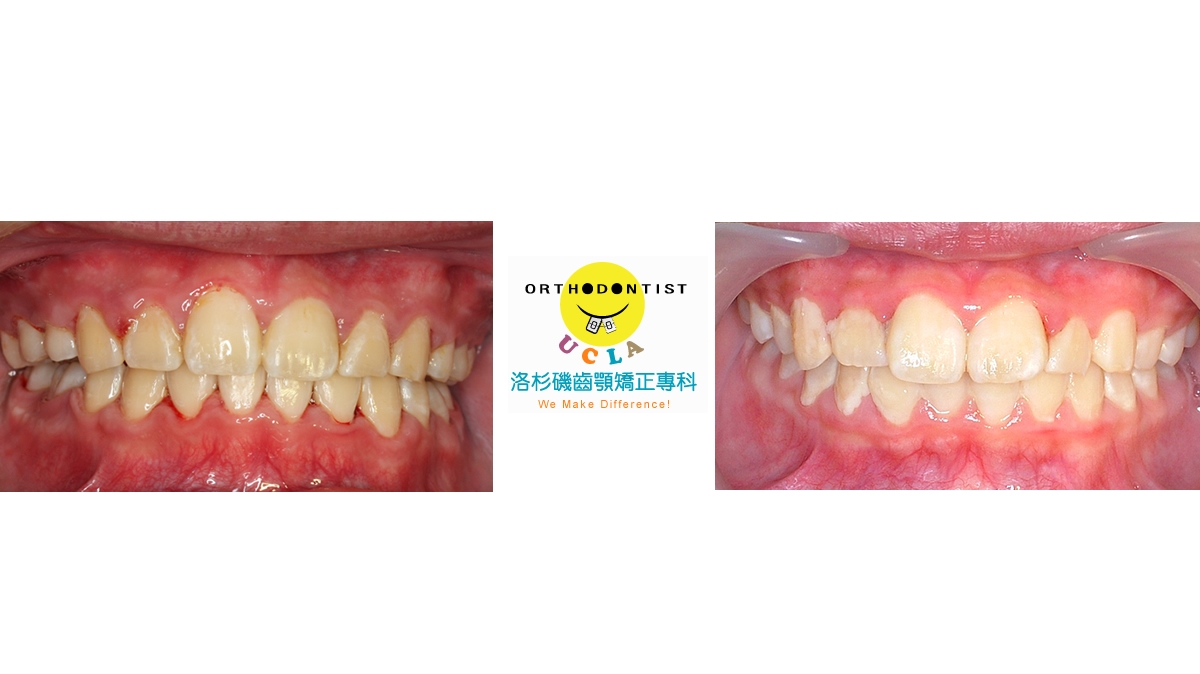 暴牙牙齒矯正對照圖三