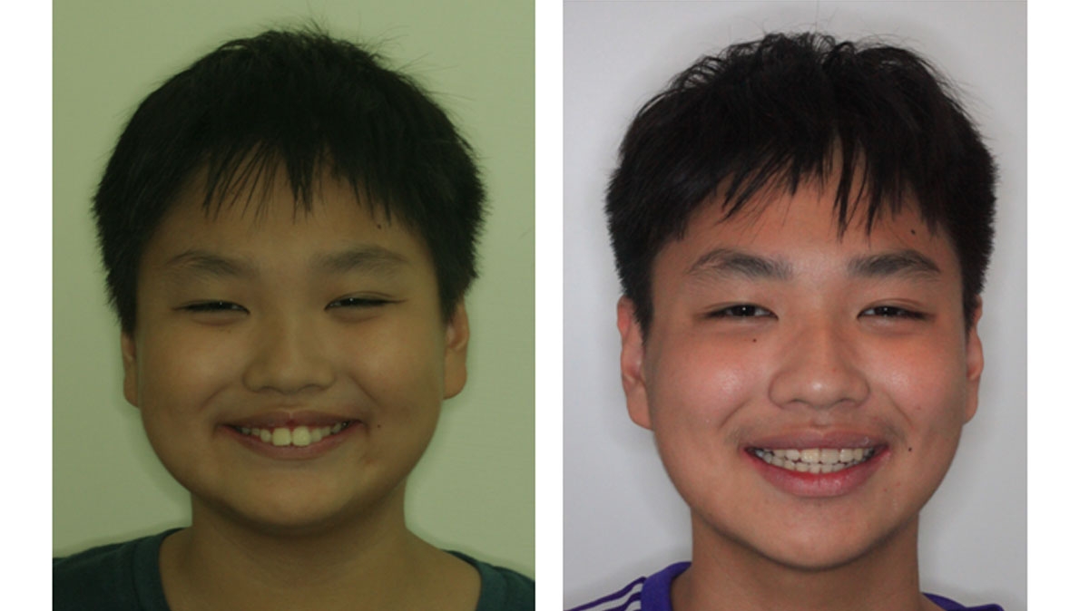 暴牙牙齒矯正對照圖