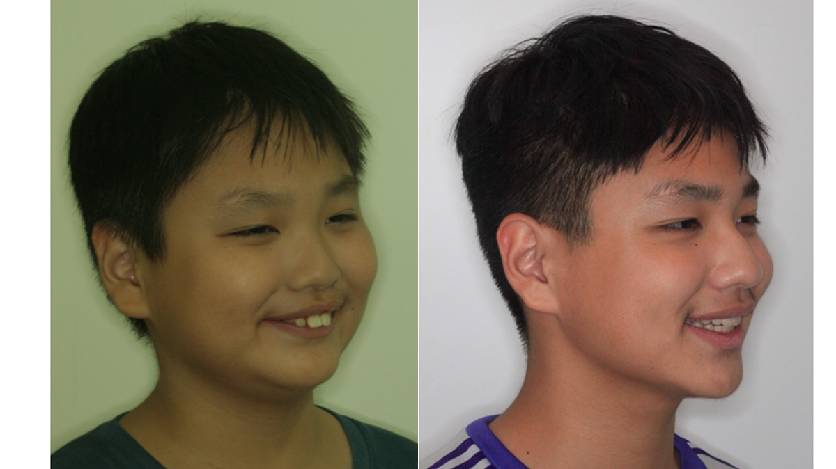 暴牙牙齒矯正對照圖二