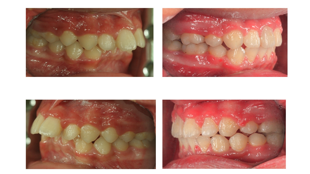 暴牙牙齒矯正對照圖三