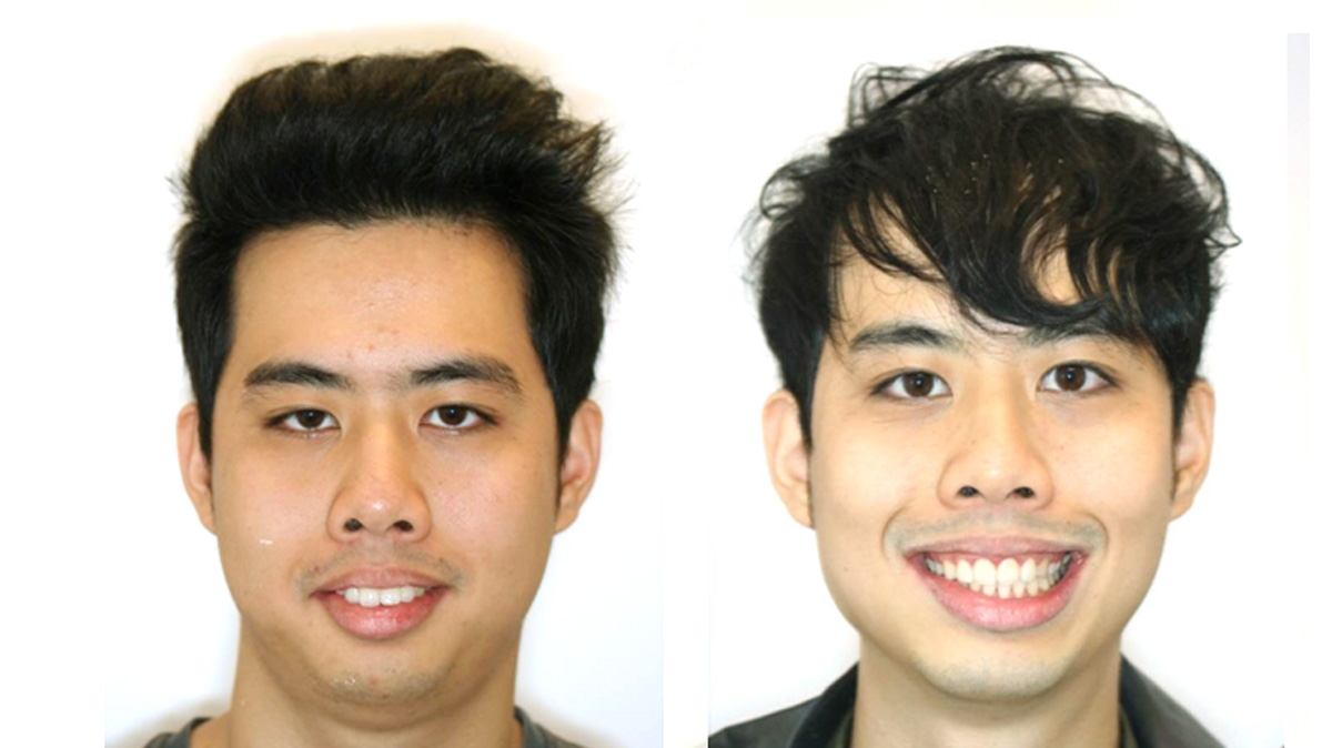 暴牙牙齒矯正對照圖