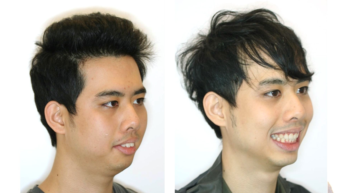 暴牙牙齒矯正對照圖二