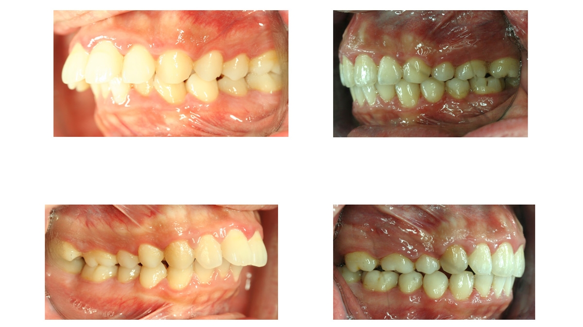 暴牙牙齒矯正對照圖三