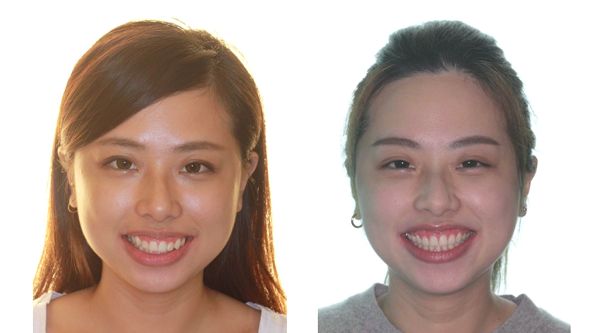 暴牙牙齒矯正對照圖