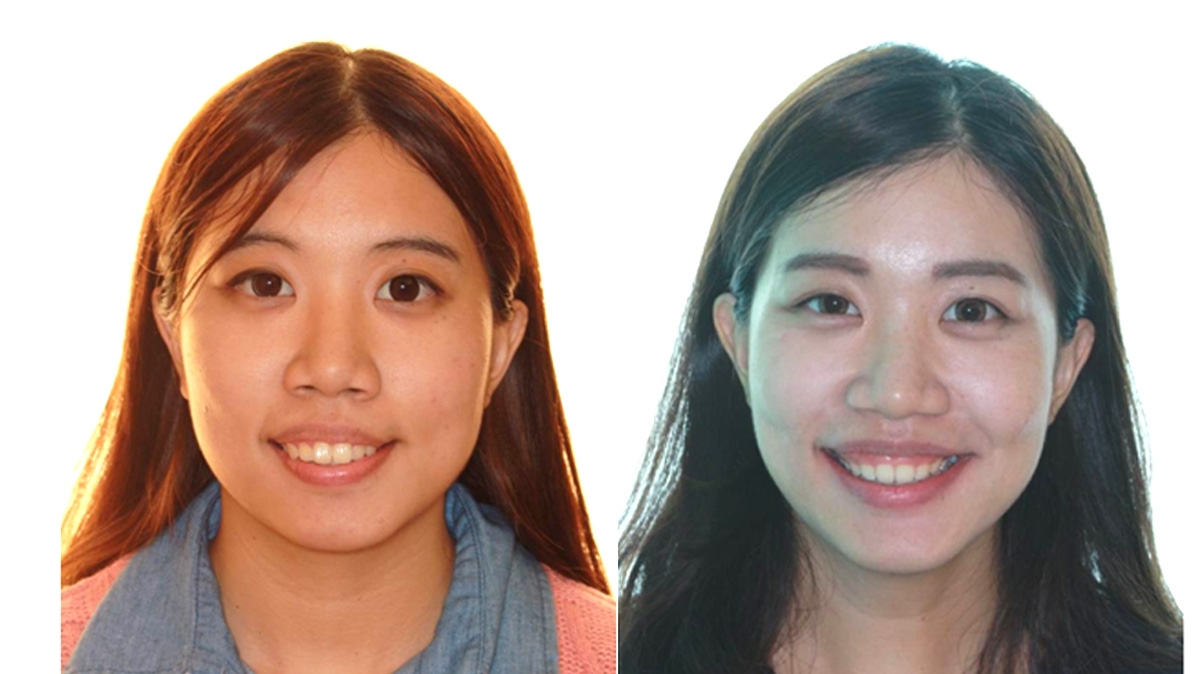 暴牙牙齒矯正對照圖