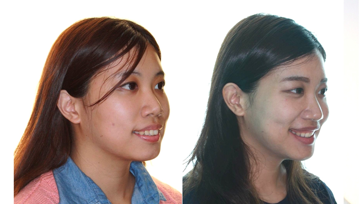 暴牙牙齒矯正對照圖二