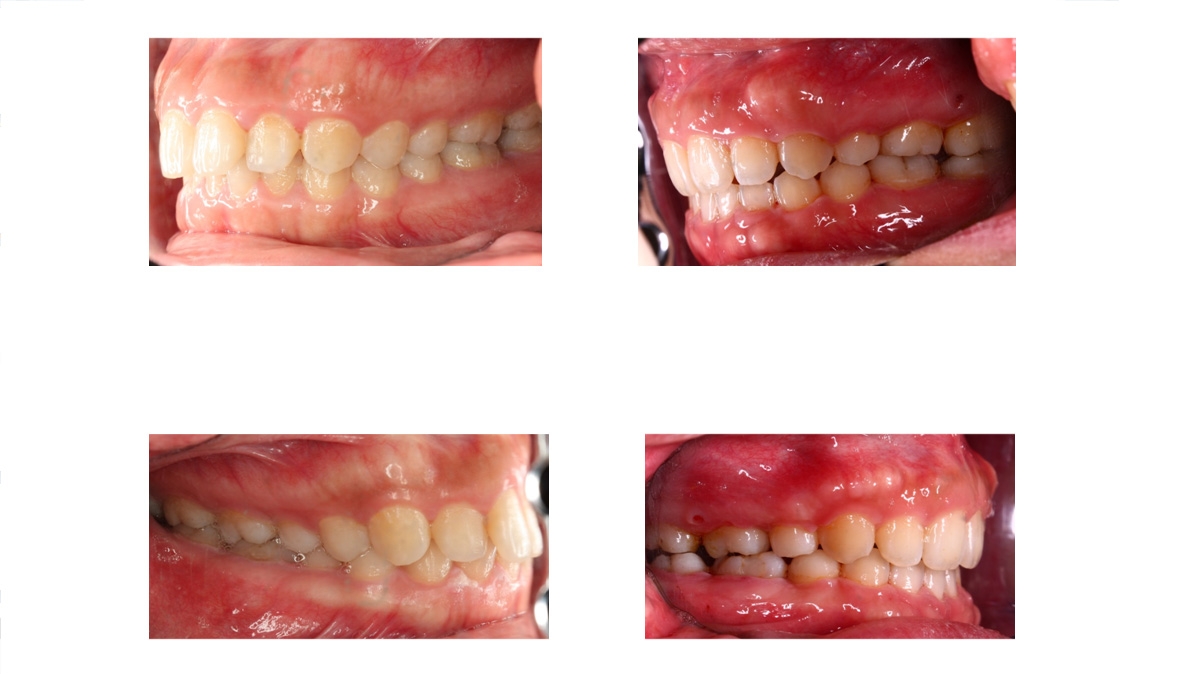 暴牙牙齒矯正對照圖三