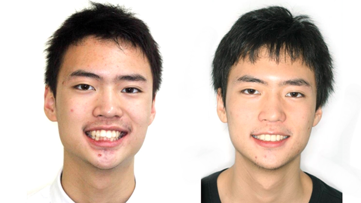 暴牙牙齒矯正對照圖