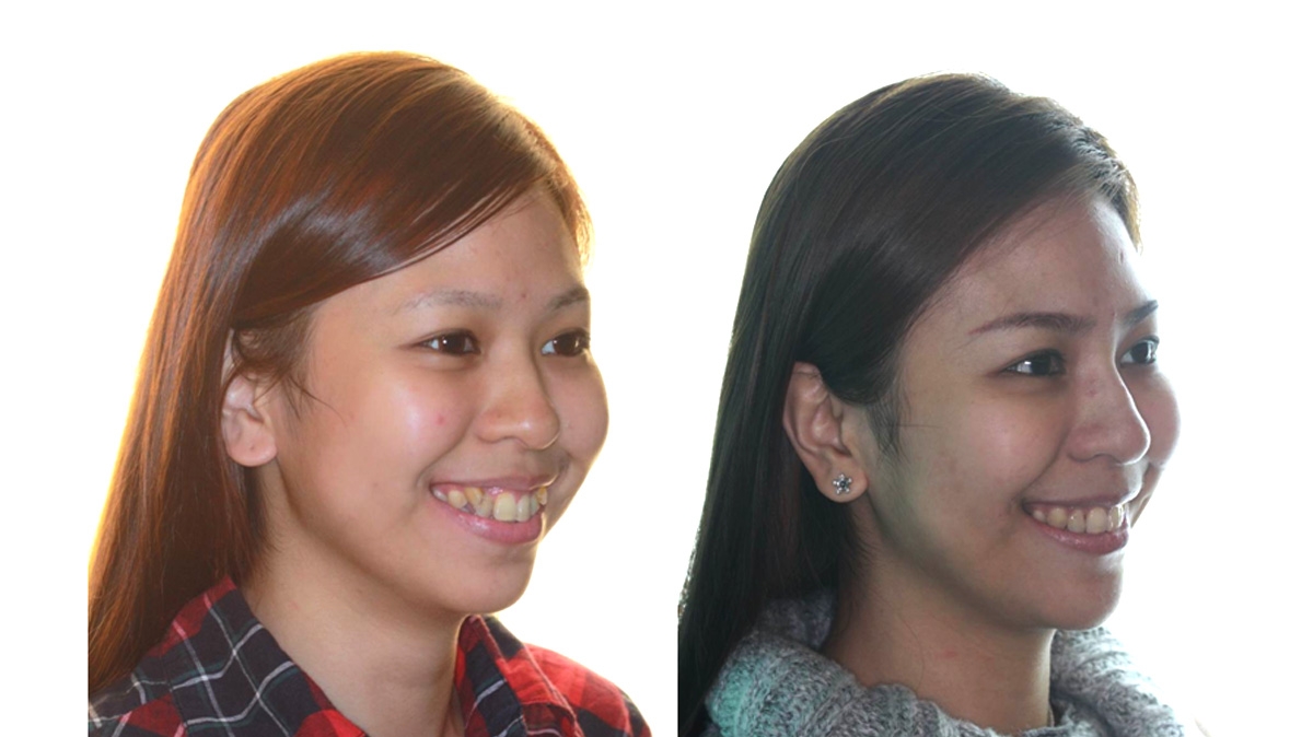 暴牙牙齒矯正對照圖二