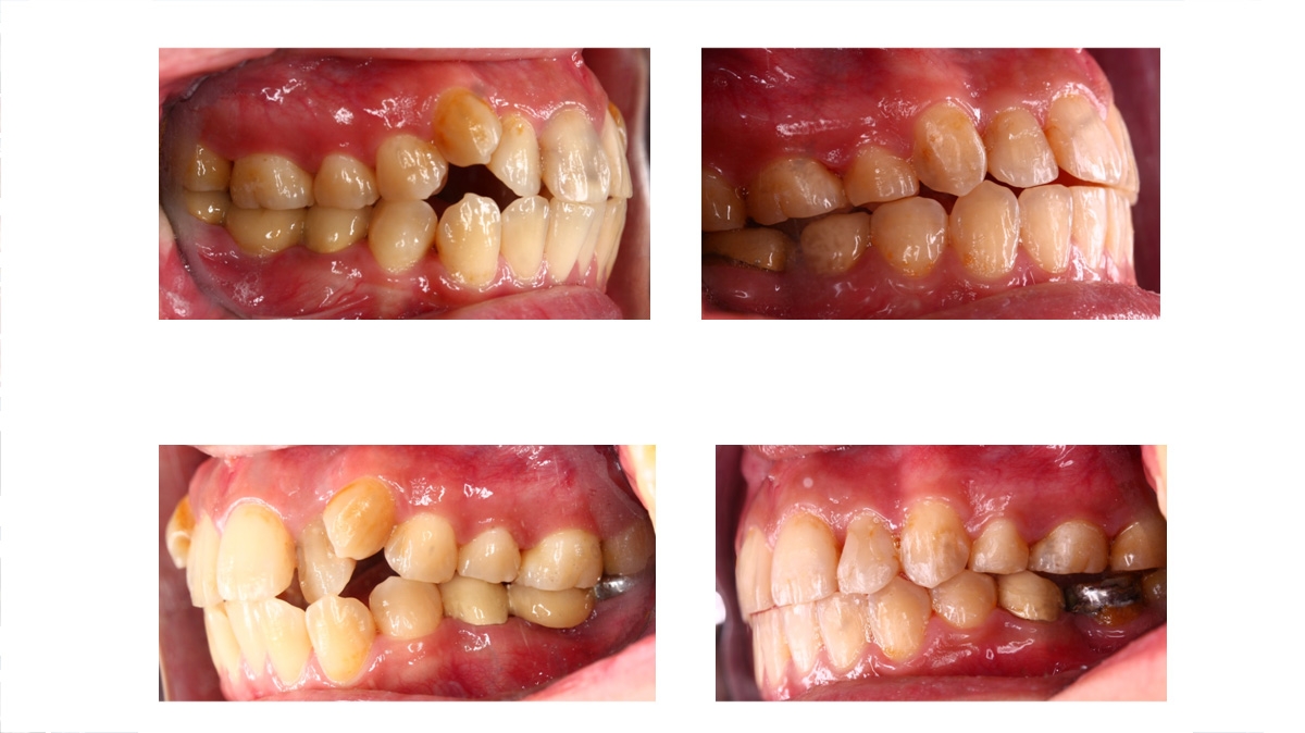 暴牙牙齒矯正對照圖三