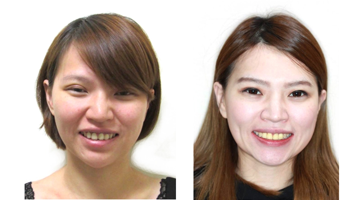 暴牙牙齒矯正對照圖