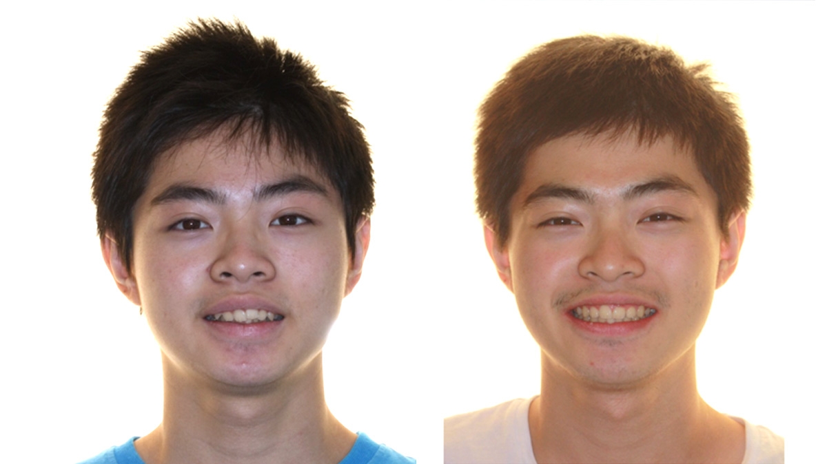 暴牙牙齒矯正對照圖