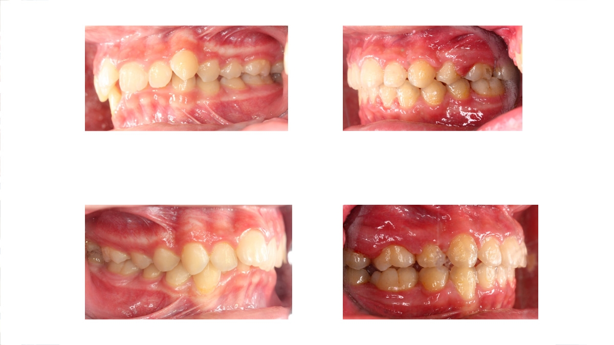 暴牙牙齒矯正對照圖三