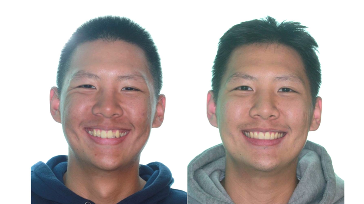 暴牙牙齒矯正對照圖