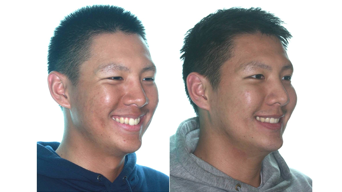 暴牙牙齒矯正對照圖二