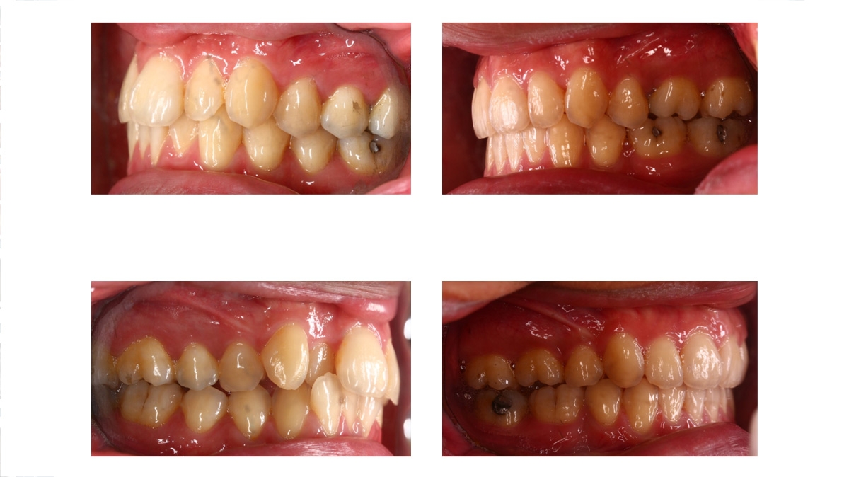 暴牙牙齒矯正對照圖三