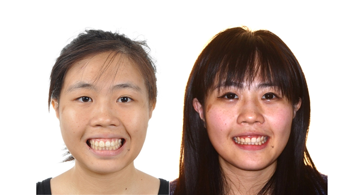 暴牙牙齒矯正對照圖
