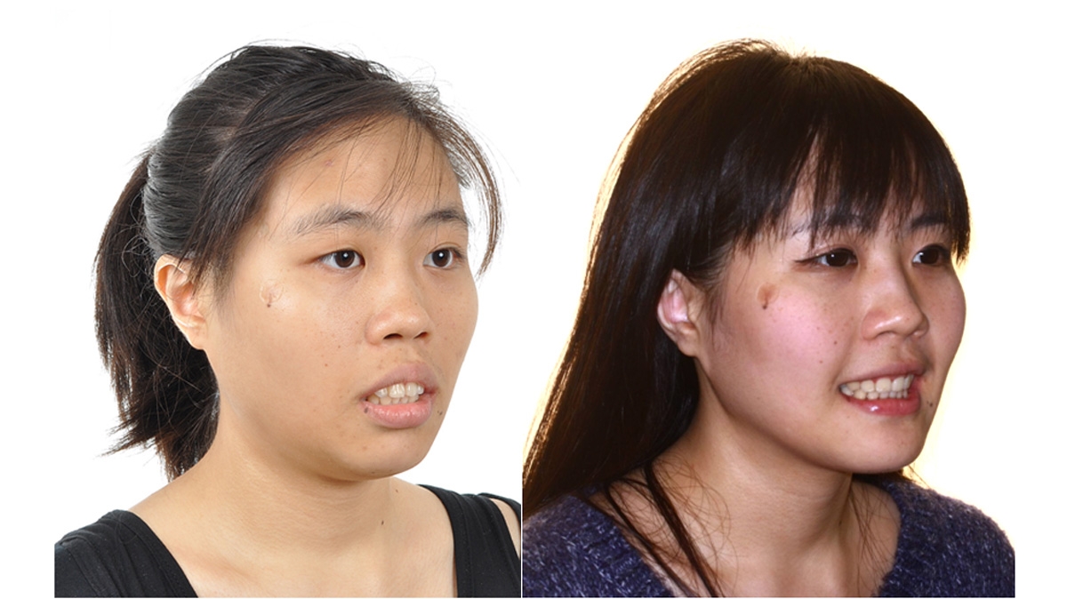 暴牙牙齒矯正對照圖二