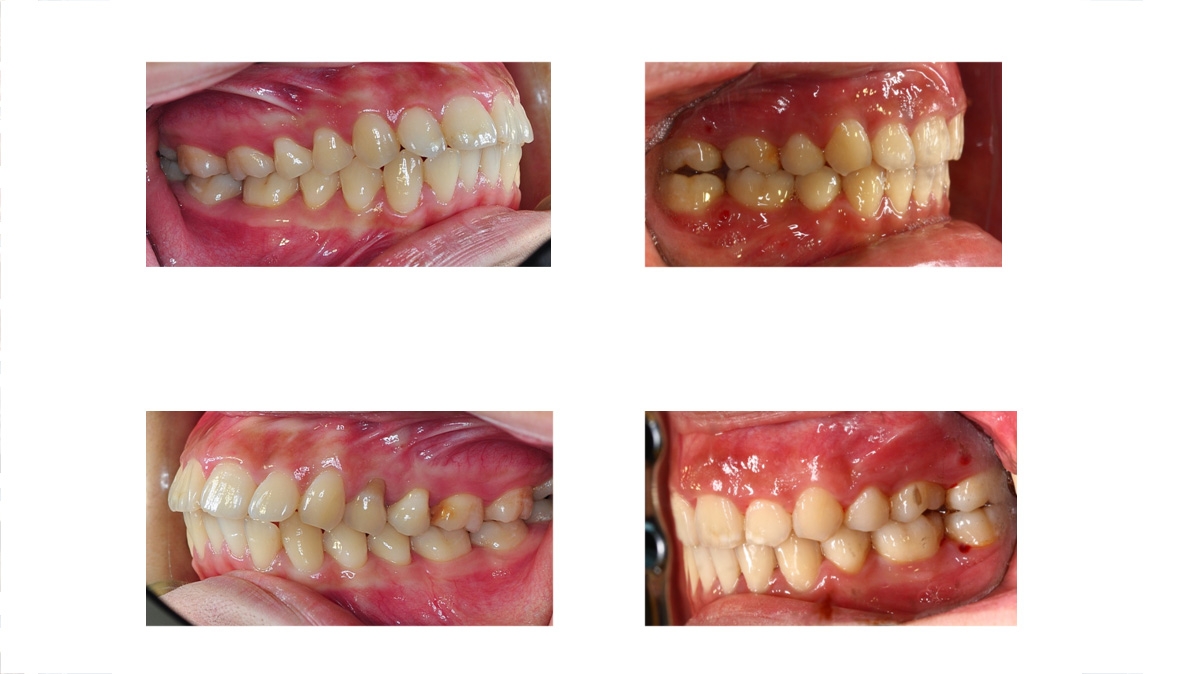 暴牙牙齒矯正對照圖三