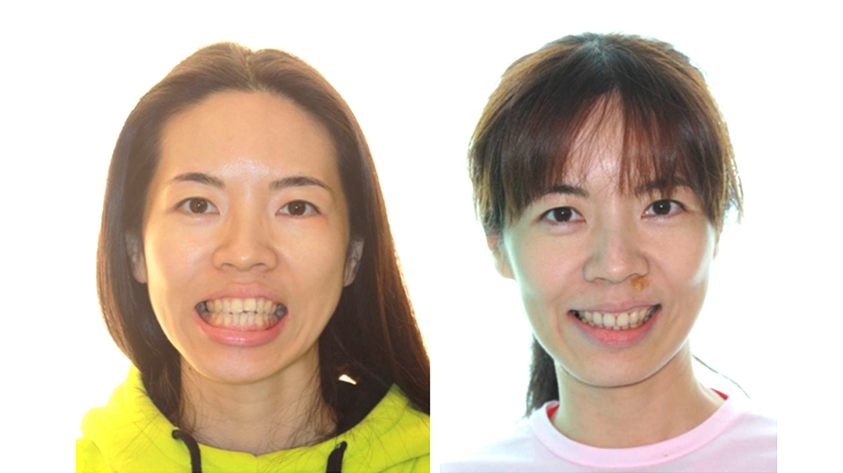 暴牙牙齒矯正對照圖