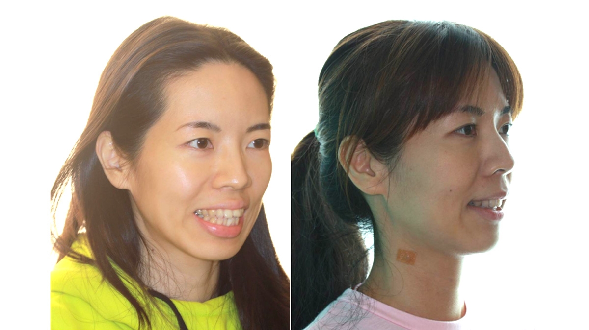 暴牙牙齒矯正對照圖二