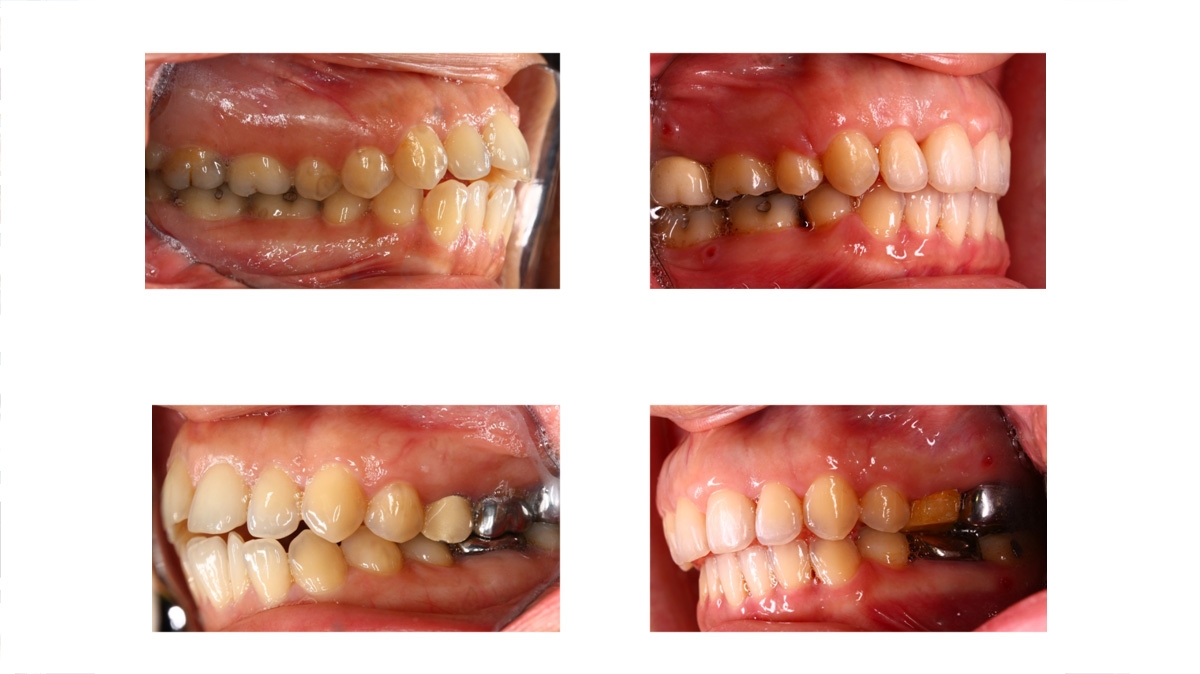 暴牙牙齒矯正對照圖三