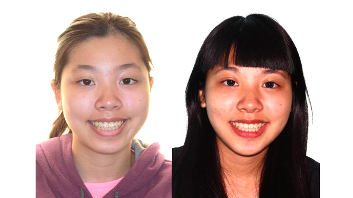 暴牙牙齒矯正對照圖