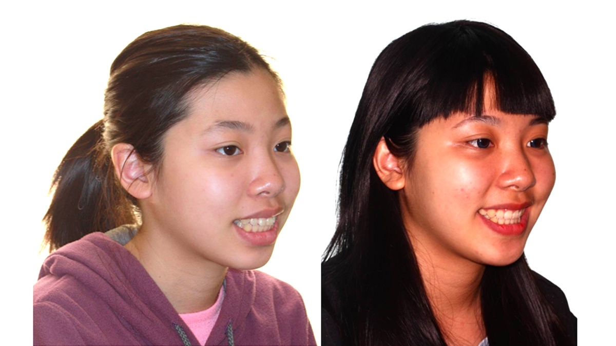 暴牙牙齒矯正對照圖二